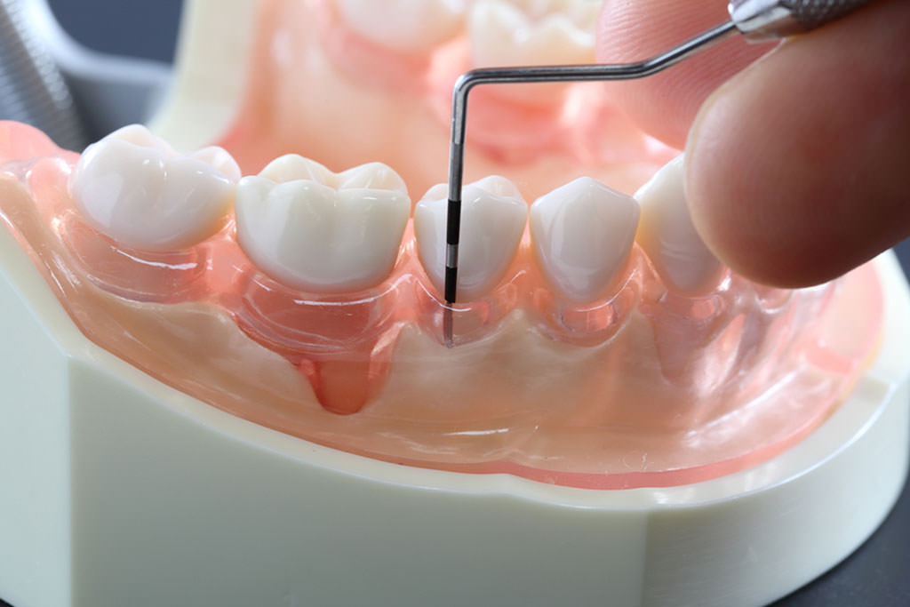 歯周病・歯周外科治療